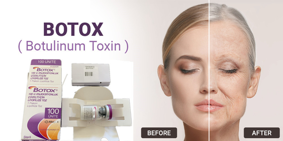 η Botulinum τοξίνη 100Units Allergan δακτυλογραφεί μια έγχυση για την του προσώπου αφαίρεση ρυτίδων