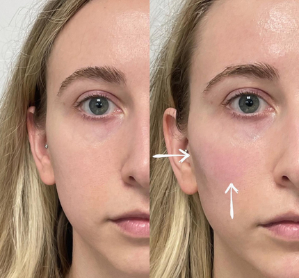 Βαθιά Hyaluronic όξινα δερμικά 2ml χειλικά υλικά πληρώσεως Skinject εκχύσιμα