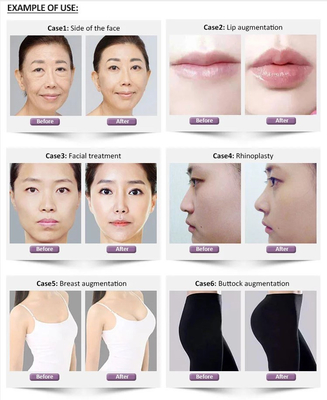 Λεπτό βαθύ υπο--q Hyaluronic όξινο διαγώνιο συνδεμένο δερμικό υλικό πληρώσεως Revolax 1.1ml