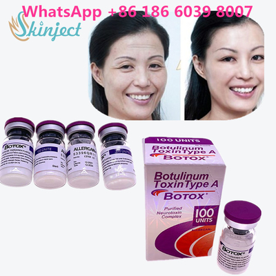 Η Botulinum αφαίρεση 100u Allergan ρυτίδων  τοξινών 100 μονάδες για το πρόσωπο ανυψώνει την έγχυση