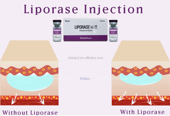10 Hyaluronidase Vias Liporase για το δερμικό υλικό πληρώσεως που διαλύει