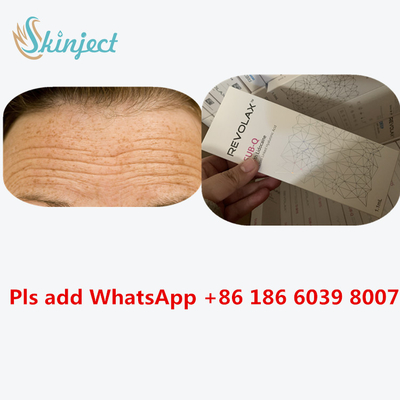 Εκχύσιμο δερμικό υλικό πληρώσεως Revolax 24 mg/$l*ml Hyaluronic όξινη έγχυση εκταρίου