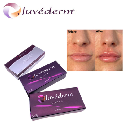 Υυλορονικό οξύ δερματικό γεμιστήρα Premium Juvederm HA Facial Filler Ultra3
