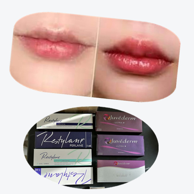 2*1ml/ Box Cross Linked Dermal Filler για την αύξηση των χειλιών