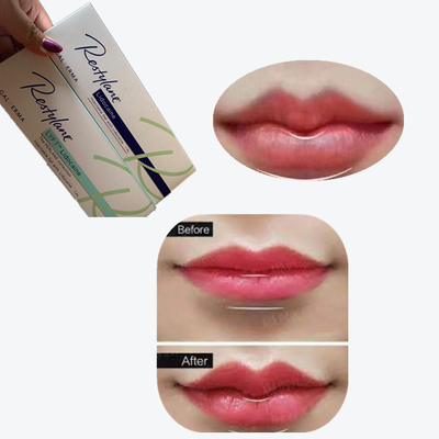 2*1ml/ Box Cross Linked Dermal Filler για την αύξηση των χειλιών