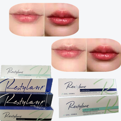 2*1ml/ Box Cross Linked Dermal Filler για την αύξηση των χειλιών