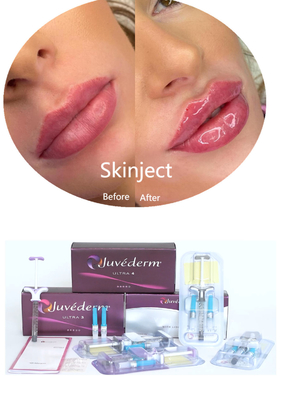 Juvederm Υαλουρονικό οξύ Πρόσωπο Δερματικό Σφραγίδιο Ενέσιμη 2*1 ml Συσκευή