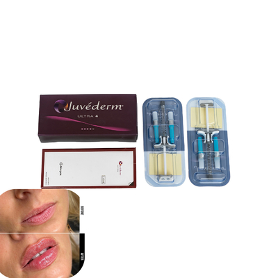 Juvederm Δερμικό Συμπλήρωμα για τα χείλη Ενέσιμα Συμπληρώματα Υαλουρονικού Οξέος