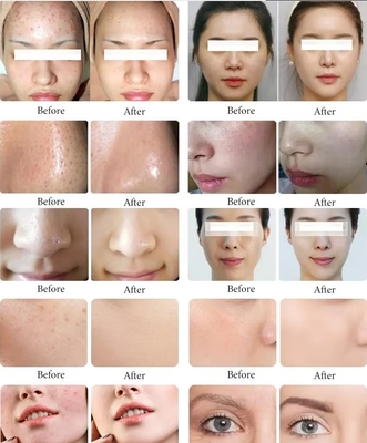 Νέα εμφάνιση Μαύρο Μαργαριτάρι 10 σε 1 Hydra Peel Machine Microdermabrasion Machine Facial Spa Micro-Touch Hydra Skin Care
