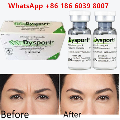 Μπότουλινική τοξίνη Dysport 100u Clostridium Botulinum Type A Για τις ρυτίδες στο μέτωπο
