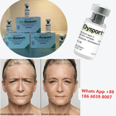 Dysport 500u Botulinum Toxin Τύπου Α για τη βελτίωση του μάγουλου