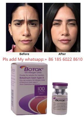 ALLERGAN Ένεση Botox Τοξίνη Βοτουλινική Τύπου Α