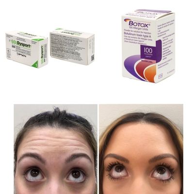 100 Μονάδες Κορέα BTX Τοξίνη Μποτουλινού για ρυτίδες και λεπτές γραμμές