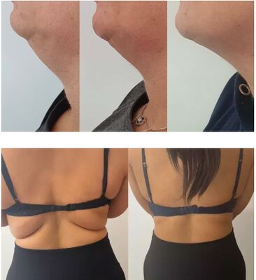 Λεμόνι Φιαλίδιο ενέσεις διάλυσης λιπαρών Λύσιμο λιπολυτικό