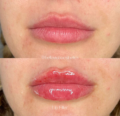 Διάρκεια ζωής 2 χρόνια ενέσιμο τζελ δερματικού πληρωτικού σχεδιασμένο για μείωση ρυτίδων, περιγράμματα προσώπου και αναζωογόνηση δέρματος