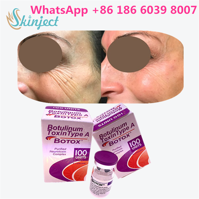 Botulinum Toxin Allergan BTX Cosmetic 100 Units – Professional Use for Smooth Forehead & Frown Lines