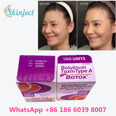 Botulinum Toxin Allergan BOTOX Cosmetic Injection 100 Units for Glabellar lines