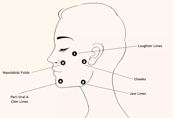 Θεραπεία Profhilo Υαλουρονικό Οξύ Skin Booster & Βιο-Αναδιαμόρφωση