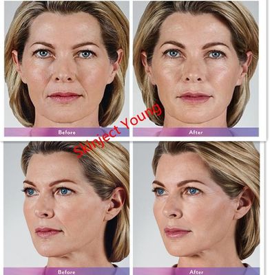 Hyaluronic όξινα εκχύσιμα υλικά πληρώσεως πηκτωμάτων Voluma 2x1ml Juvederm