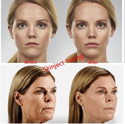 Hyaluronic όξινα εκχύσιμα υλικά πληρώσεως πηκτωμάτων Voluma 2x1ml Juvederm