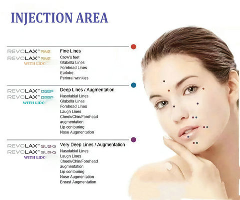 Hyaluronic όξινα του προσώπου υλικά πληρώσεως Revolax για την του προσώπου διεύρυνση