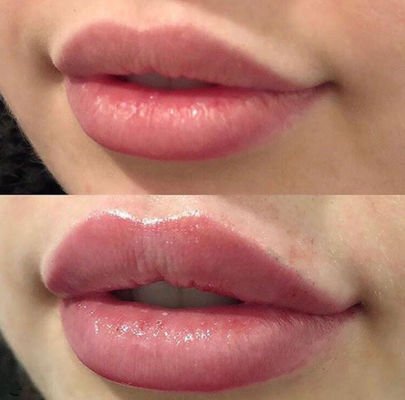 Ρωσικά χείλια Juvederm εξαιρετικά 3 με το συνδεμένο σταυρός δερμικό υλικό πληρώσεως λιδοκαΐνης