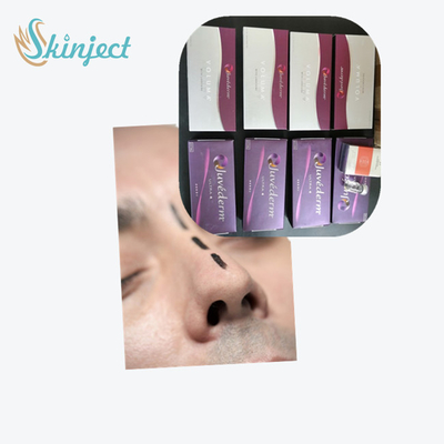 Hyaluronic όξινο δερμικό υλικό πληρώσεως Juvederm Ultra3 για τα χείλια