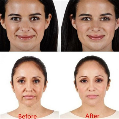 Δερμικό υλικό πληρώσεως εκχύσιμο Juvederm ρυτίδων χειλικών εγχύσεων υλικών πληρώσεως εκταρίου 2ml