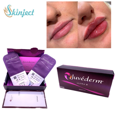 Nasolabial χειλικό 2x1ml δερμικό υλικό πληρώσεως Hyaluronic όξινο Juvederm Ultra3 πτυχών