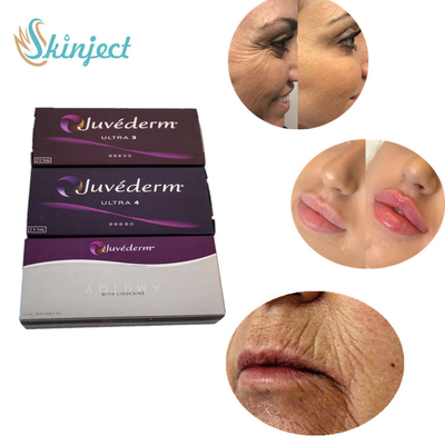 Juvederm εξαιρετικά 4 δερμικές χειλικές εγχύσεις υλικών πληρώσεως για την προκλητική χειλική αύξηση
