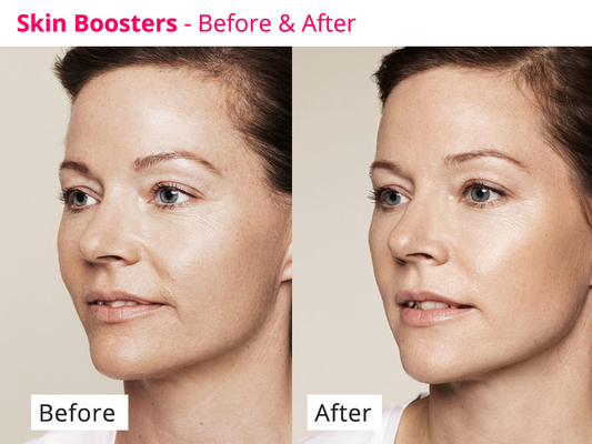 Μέσος ορός Rejuvenating PDRN Skinbooster δερμάτων για την αναγέννηση κολλαγόνων