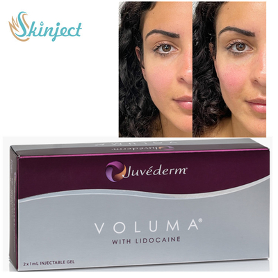 Δερμικά υλικά πληρώσεως Voluma 2x1ml εκτάριο Juvederm για τη χάραξη περιγράμματος πηγουνιών ζυγωματικών