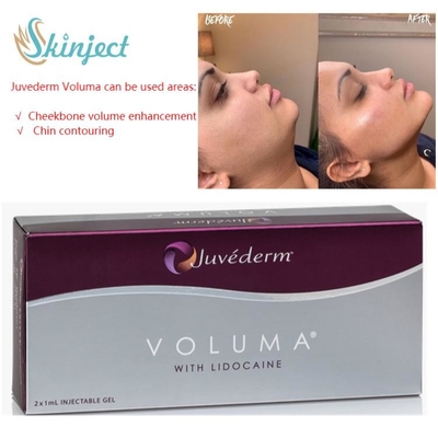 Hyaluronic όξινα δερμικά υλικά πληρώσεως Voluma 2x1ml Juvederm για το ζυγωματικό