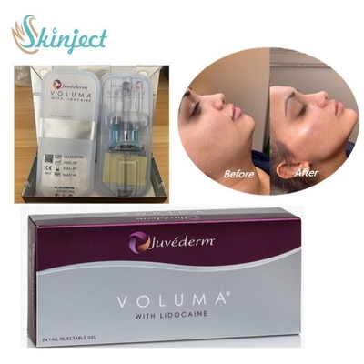 Juvederm Hyaluronic οξύ υλικών πληρώσεως Voluma δερμικό για το του προσώπου περίγραμμα πηγουνιών μάγουλων