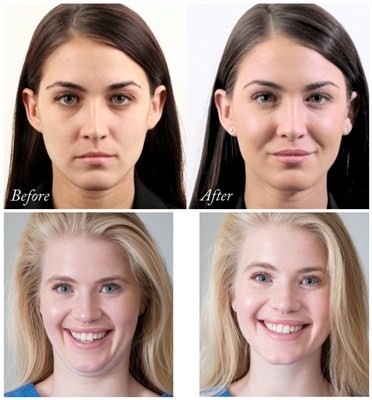 Hyaluronic όξινο του προσώπου υλικό πληρώσεως Juvederm Voluma βελτίωσης 24 mg/$l*ml