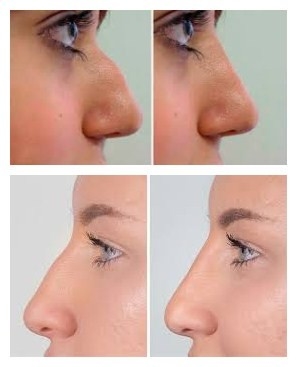 Hyaluronic όξινο του προσώπου υλικό πληρώσεως Voluma Juvederms για την αύξηση πηγουνιών και μάγουλων