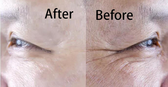 Hyaluronic όξινη λεύκανση αναγέννησης κολλαγόνων υλικών πληρώσεως και αντι έγχυση γήρανσης