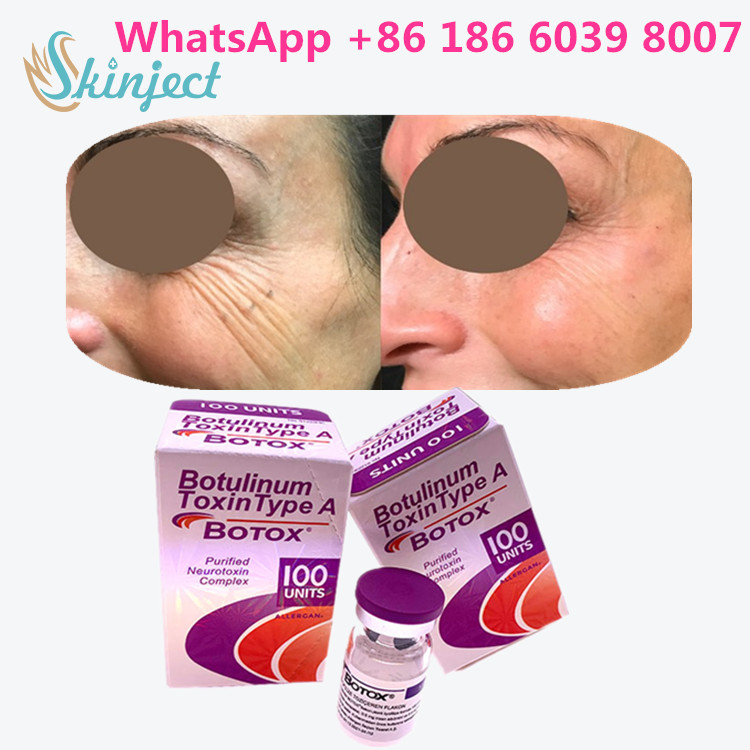 Η Botulinum τοξίνη Allergan  δακτυλογραφεί μια συσκευασία φιαλιδίων/παραθύρων 100units 1