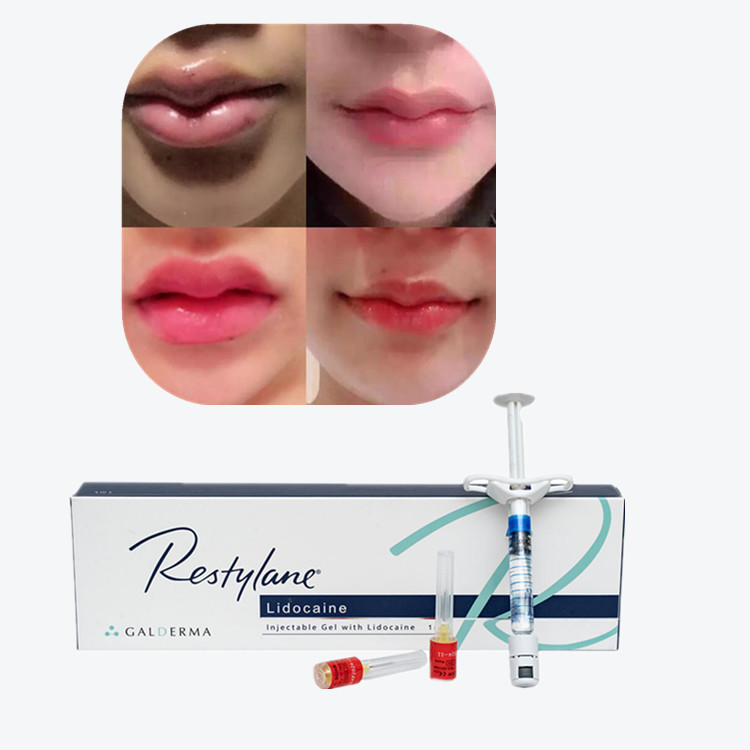 Το Juvederm Cross Linked Injectable Dermal Filler για τα χείλη