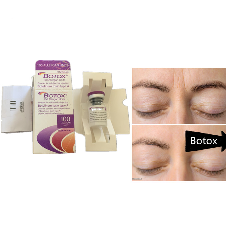 Allergan 100ui Botulinum Toxin Serum Αντιγήρανση Προϊόν για Δυσπορτική Εικόνα