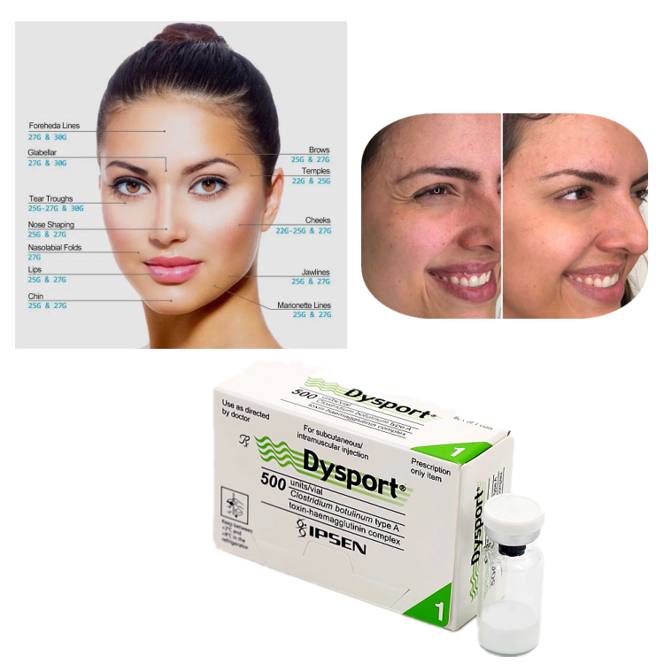 Dysport 500U Botulinum Toxin Type A για τη θεραπεία ρυτίδων