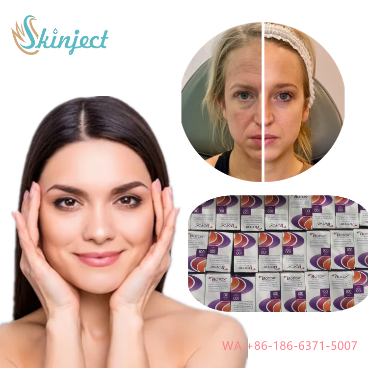 Allergan Botox Nobota 100u 200u για αποτελεσματική θεραπεία των ρυτίδων έκφρασης Ενέσεις τοξίνης αλλαντίασης