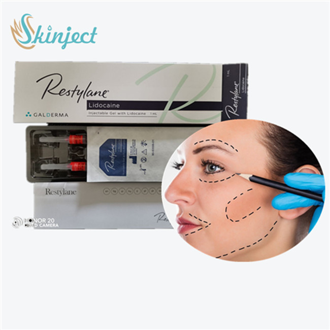 Hyaluronic όξινο υλικό πληρώσεως στηθών  για τις γέρνοντας στοματικές γωνίες