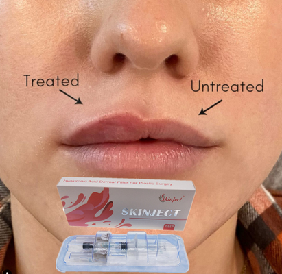 Εκχύσιμες βαθιές Hyaluronic όξινες δερμικές Nasolabial πτυχές πηγουνιών μάγουλων χειλικών υλικών πληρώσεως 2ml