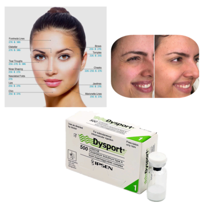Dysport 500U Botulinum Toxin Type A για τη θεραπεία ρυτίδων